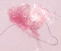 Morgellons